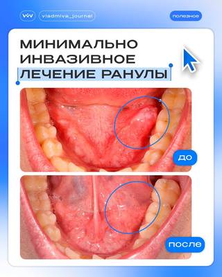 Киста под языком: клинический случай от хирурга Попова.